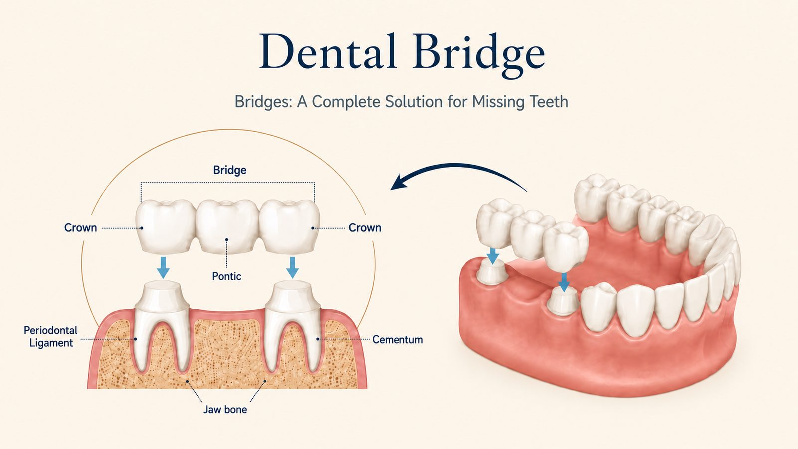 Dental bridge diagram